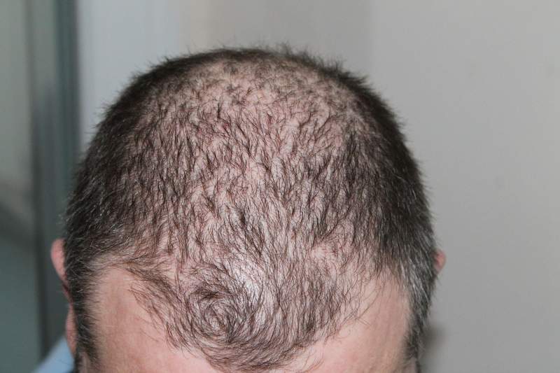 hair-loss-head